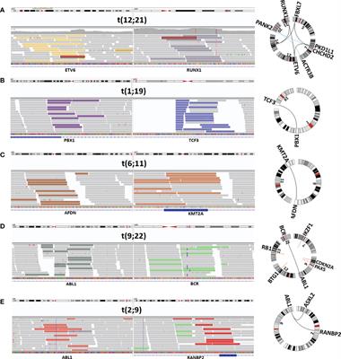 Feasibility to use whole-genome sequencing as a sole diagnostic method to detect genomic aberrations in pediatric B-cell acute lymphoblastic leukemia